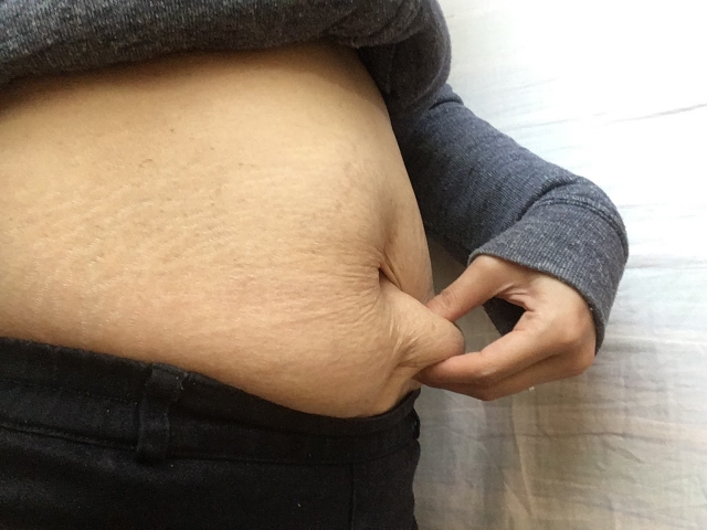 更年期特有の下腹部の脂肪をつまんでいる様子。産後や加齢によるポッコリお腹の悩み。福岡市東区の痩身ダイエット専門店ニドムの改善事例。